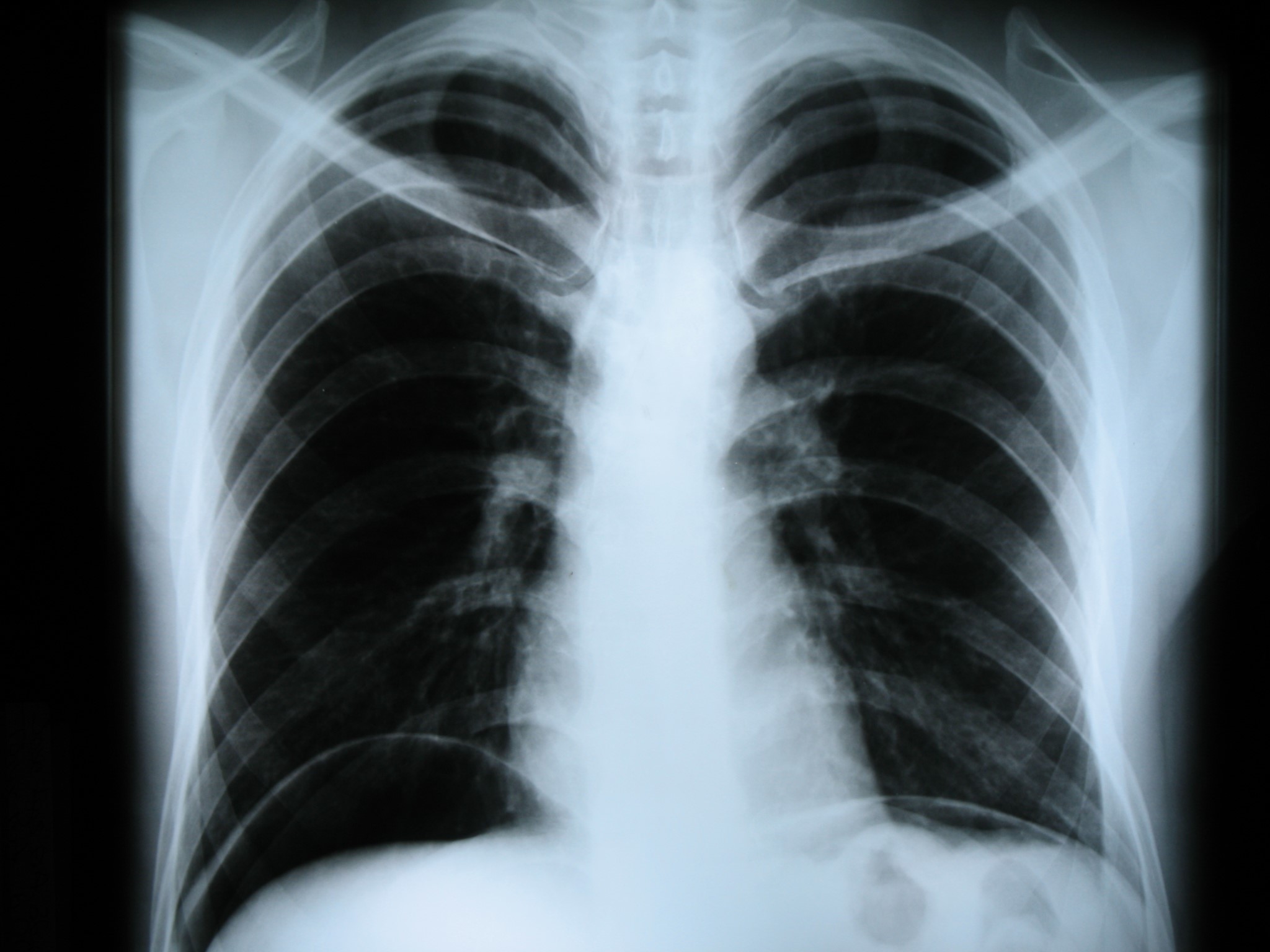 Рентгенограмма органов грудной клетки в прямой проекции. Видно скопление воздуха под куполами диафрагмы