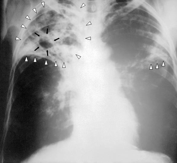 Рентгенограмма органов грудной клетки больного туберкулёзом лёгких с распадом