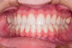 Установка имплантов – гарантия здоровья зубов